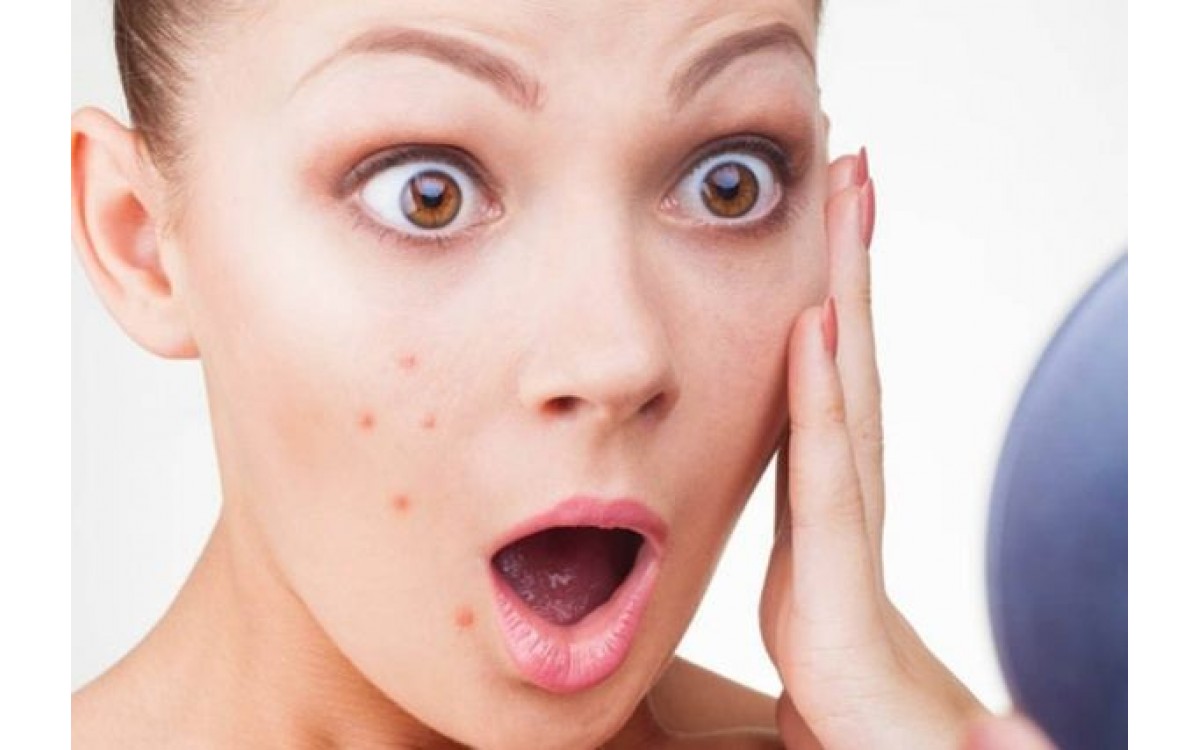 Mụn trứng cá nỗi lo không chỉ riêng ai